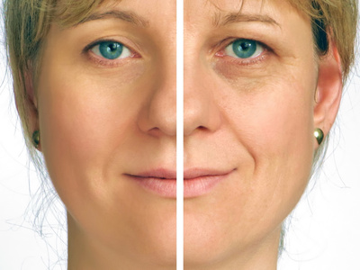 Face lift without surgery