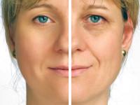 Natural facelift, South London